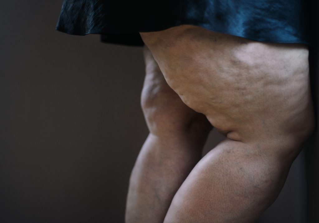 lipedema