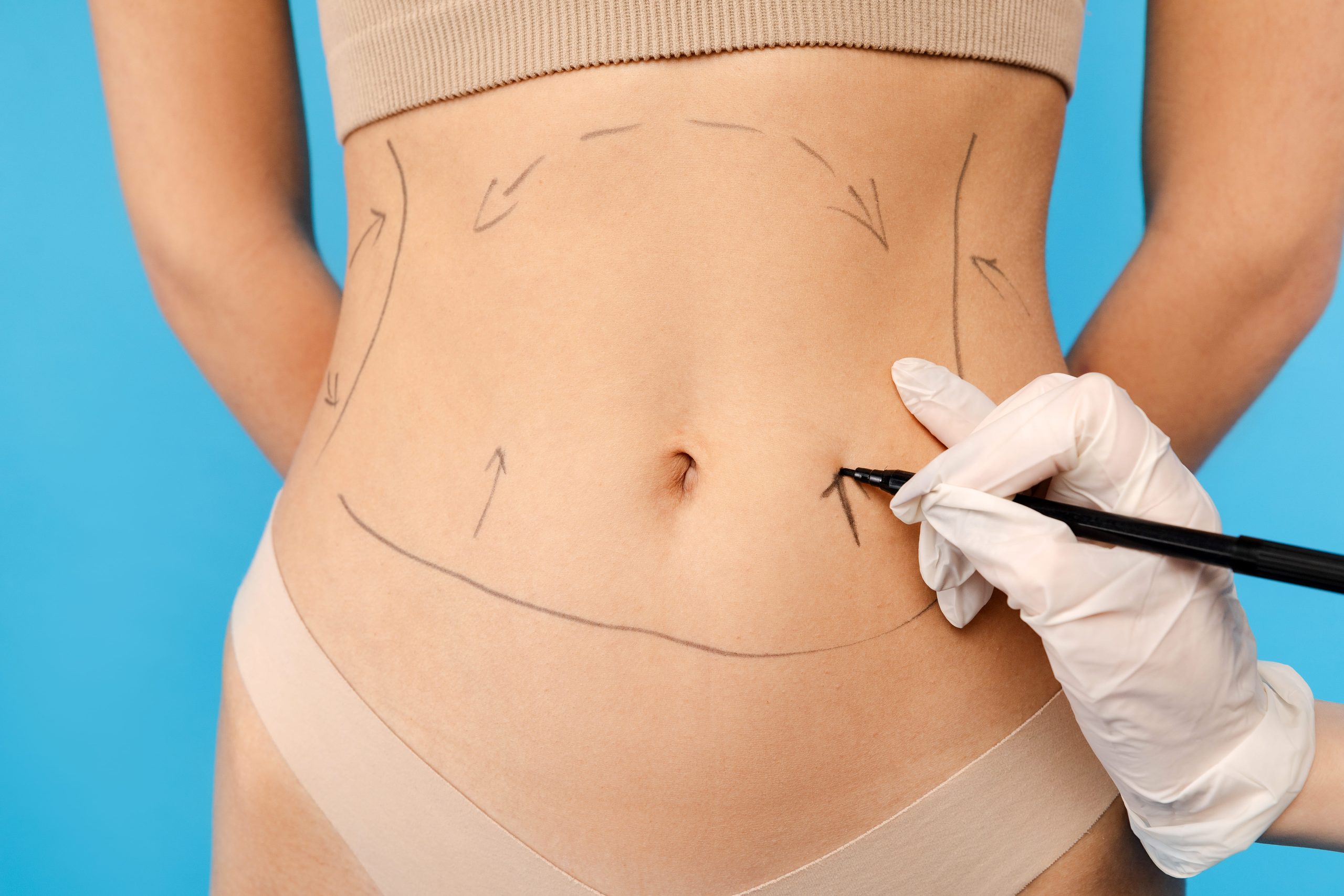 Mini Abdominoplastia